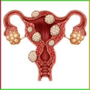 FibroFit Pack – A Natural Solution for Uterine Fibroids